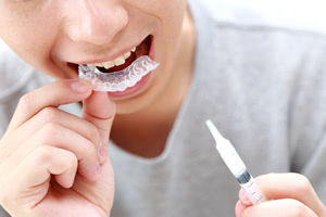 ホワイトニングをすれば、歯は白くなる？