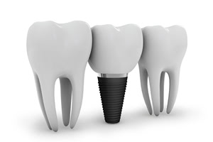 仮歯とは本物の人工歯の前につける「テスト用」