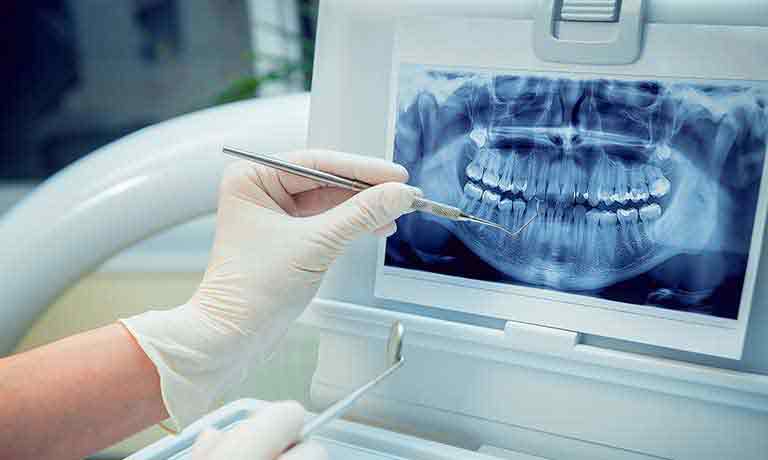 お口の嚢胞や粘膜トラブルに対する治療