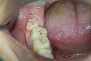 wisdom_tooth_02