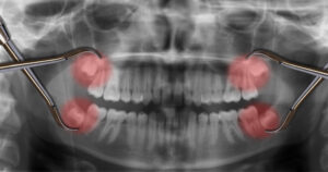 wisdom_tooth_01