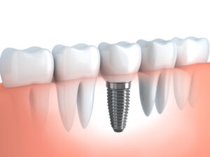 bridge_implant_02