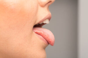 dry_mouth_02