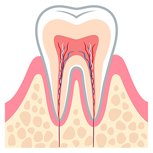 歯の神経を取ったらどうなる？メリット・デメリットと治療後の３つの注意点