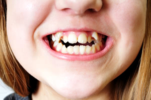 日本と海外では「八重歯」の印象が大きく異る
