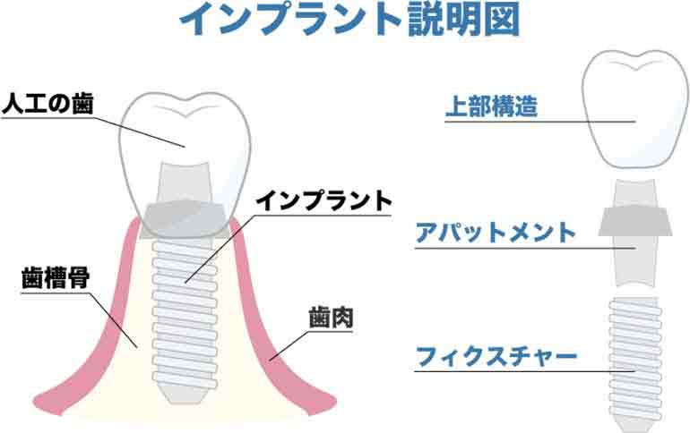 インプラント説明図