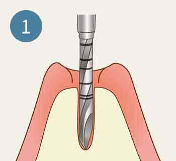インプラント 工程1