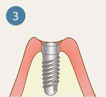 インプラント 工程3