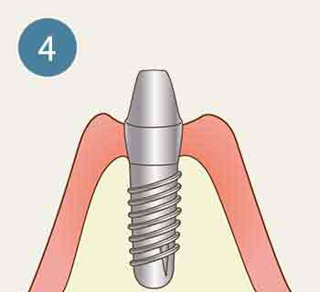 インプラント 工程4