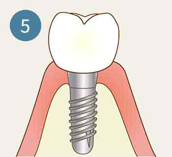 インプラント 工程5