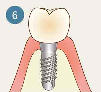 インプラント 工程6