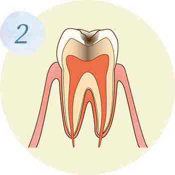 C1,C2：エナメル質、象牙質に達する虫歯イラスト