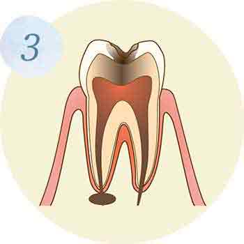 C3：神経に達する虫歯イラスト