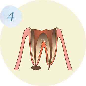 C4：歯根のみの状態イラスト