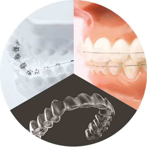 大人の歯列矯正器具　イメージ