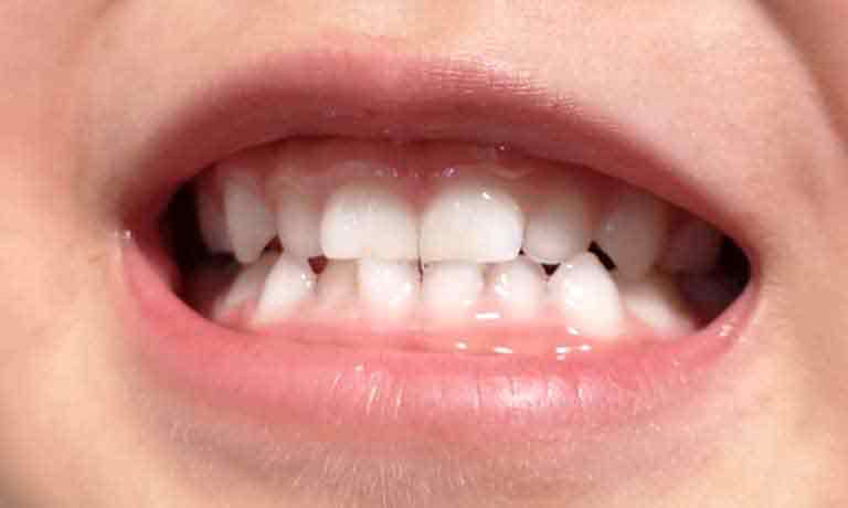 子供の歯と口