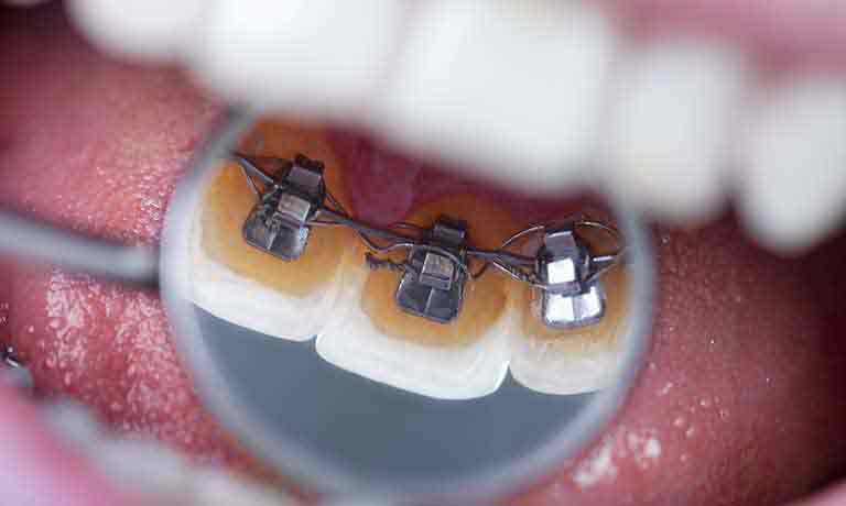 歯列矯正 イメージ
