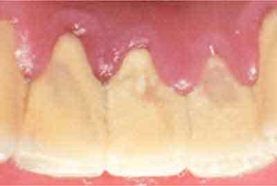 歯石のついた歯のイメージ