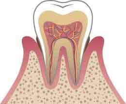 軽度の歯周炎のイメージ