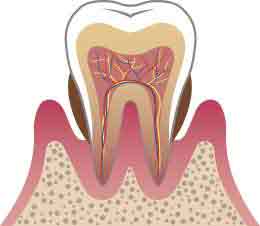 中等度歯周炎のイメージ