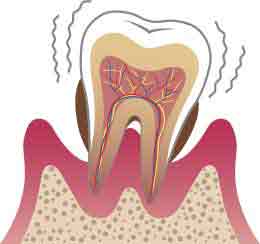 重度歯周炎のイメージ