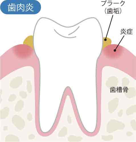 歯肉炎のイメージ