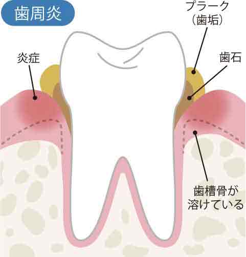 歯周炎のイメージ