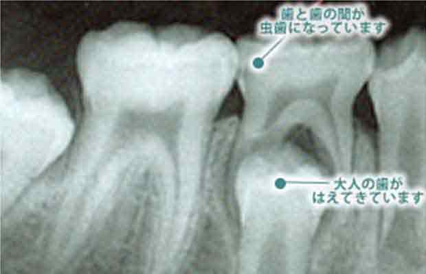 同じところをX線で見た写真