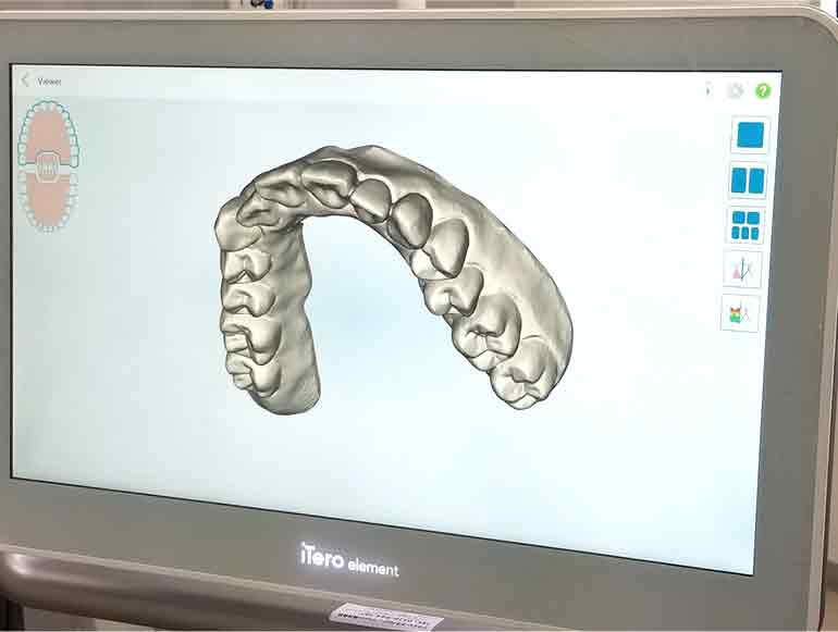 iTeroエレメント